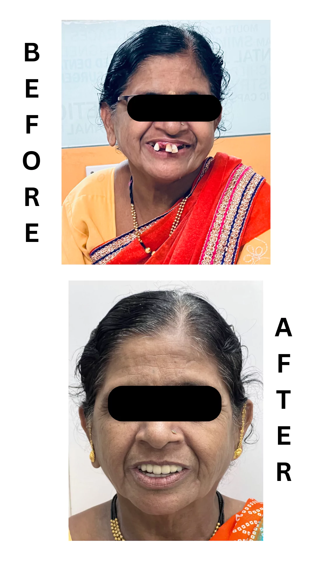 Face N Dental International Clinic befor and after dental implants image2