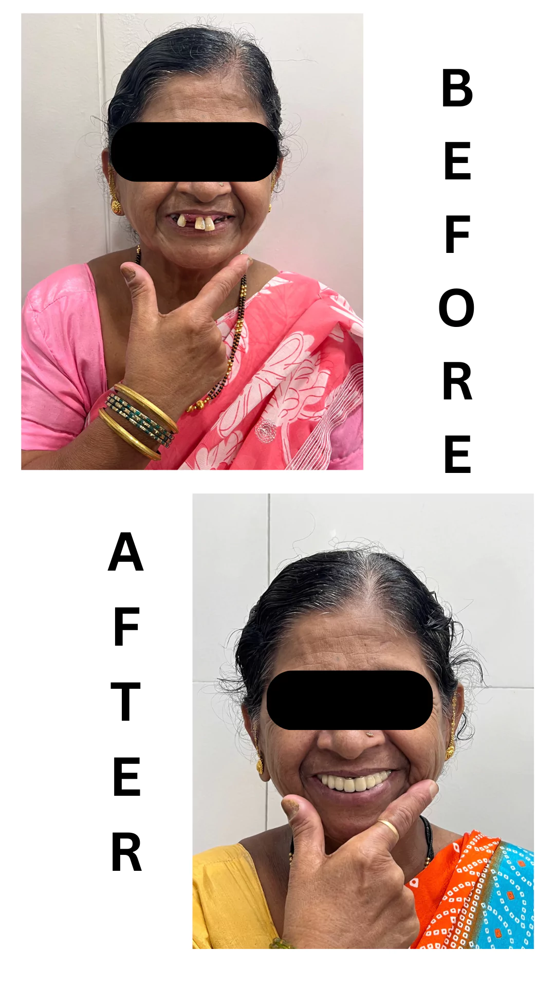 Face N Dental International Clinic befor and after dental implants image1