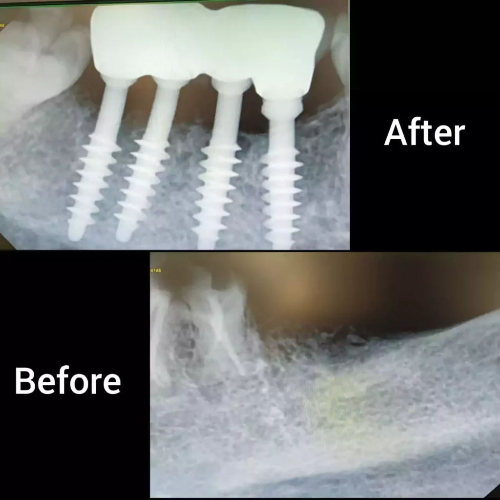 Face N Dental International Clinic Dental Implant before and after image1 In Nigdi Pune