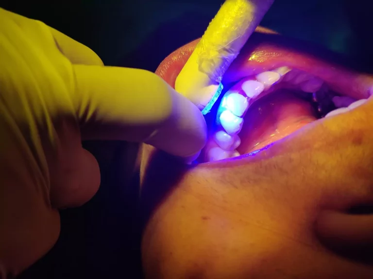 Face N Dental International Clinic in Nigdi Pimpri Chinchwad Aligners and Ortho image2