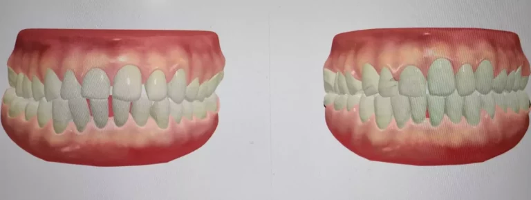 Face N Dental International Clinic in Nigdi Pimpri Chinchwad orthodontic treatment