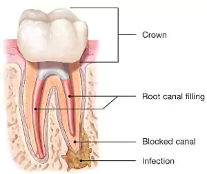 Face N Dental International Clinic Advance Root Canal Treatment in Nigdi Image1