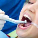 teeth cleaning services at Face N Dental International Clinic in Nigdi Pimpri Chinchwad