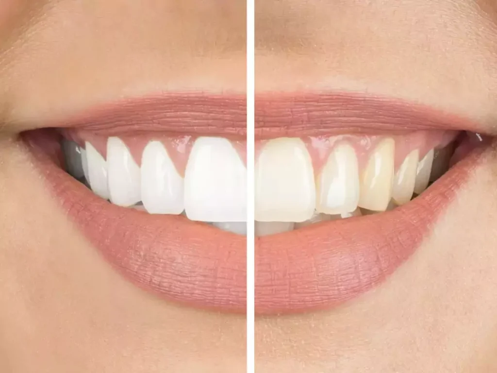 laser teeth whitening machine